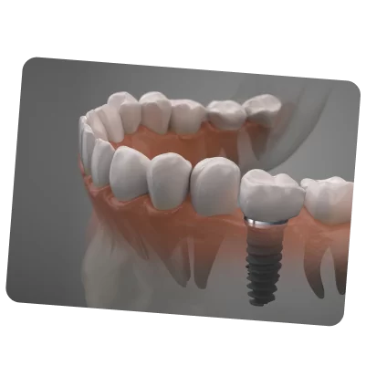 Имплантация зубов за 49 500 руб. включая коронку