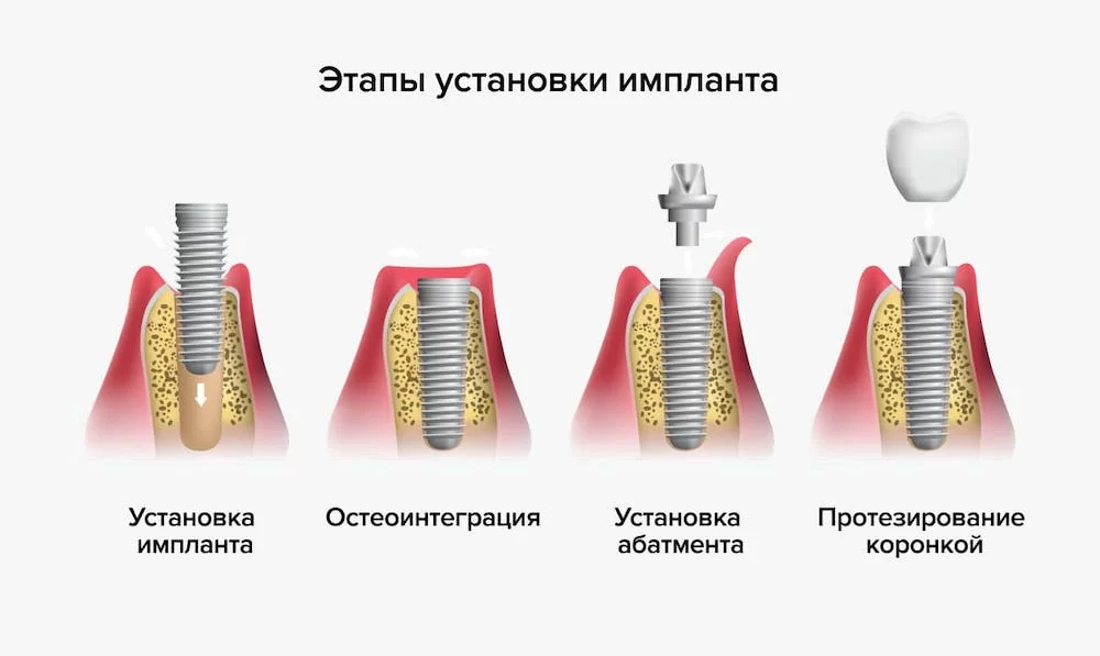 Имплантация зубов: этапы и сроки