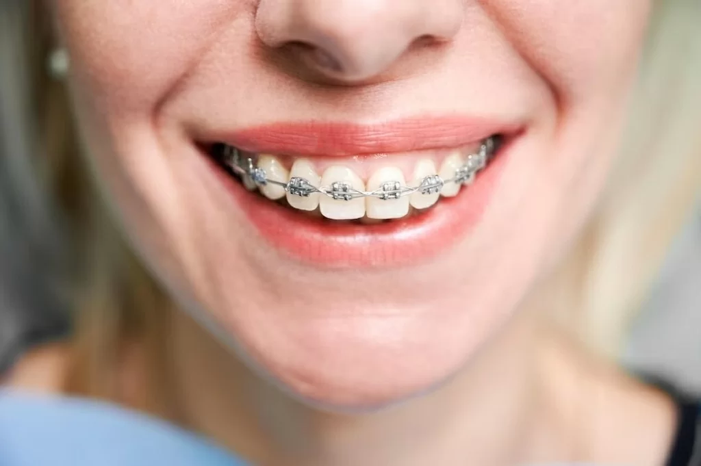 smiling-young-woman-with-braces-teeth.jpg