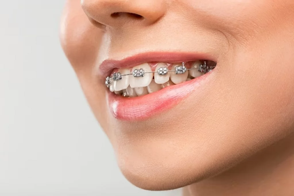 beautiful-young-woman-with-teeth-braces.jpg