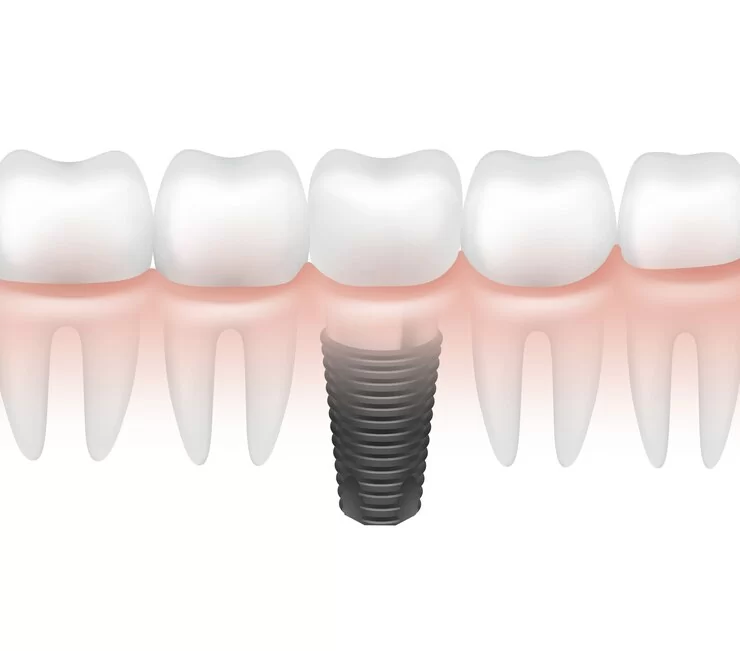 vector-metal-dental-implant-other-teeth-gum-side-view-isolated-white-background_1284-45549.jpg
