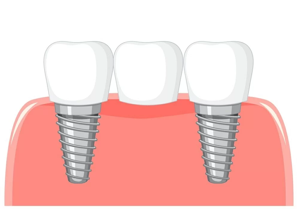 dental-bridge-gum-white-background_1308-93152.jpg