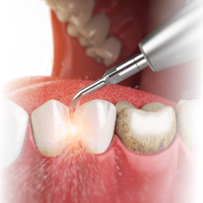 Чистка зубов аппаратами EMS