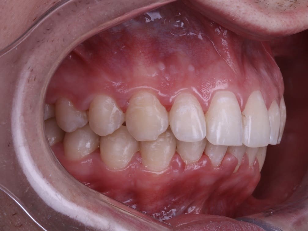 Стоматология Денттайм Качаева ортодонт. После лечения, вид сбоку