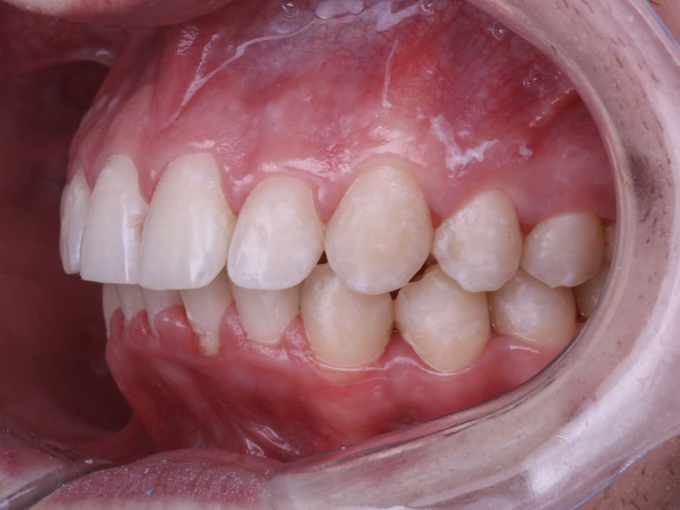 Стоматология Денттайм Качаева ортодонт. После лечения, вид сбоку 2