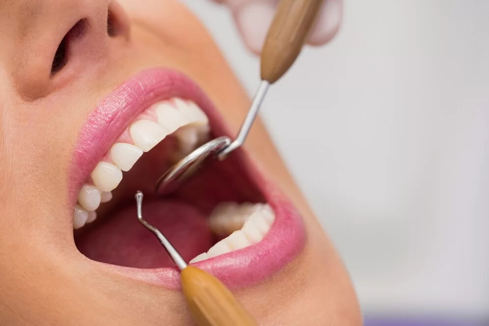 Что такое сепарация зубов и когда ее применяют?